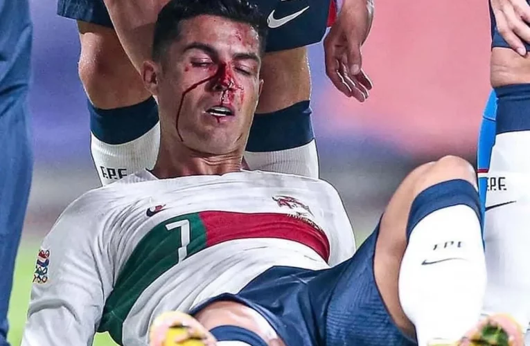 Cristiano Ronaldo sufrió un aparatoso #golpe en la nariz
